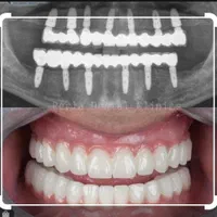 ایمپلنت اقتصادی|خدمات آرایشگری و زیبایی|تهران, فدک|دیوار