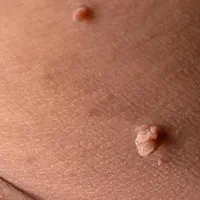 برداشت خال،اسکین تگ،زگیل،کک ومک واسترج مارک|خدمات آرایشگری و زیبایی|شاهین‌شهر, فیض|دیوار