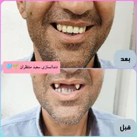 دندان مصنوعی/ دندانسازی ضمانتی/بیش ازنیم قرن تجربه|خدمات آرایشگری و زیبایی|مشهد, کوشش|دیوار