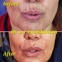 بوتاکس ژل فیلر مزوتراپی لیزر هایفو لیفت نخ در مطب|خدمات آرایشگری و زیبایی|اصفهان, مسجد مصلی|دیوار