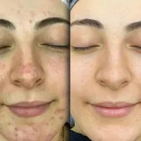 ترمیا (رفع جای جوش/جوانسازی/کلاژنسازی)|خدمات آرایشگری و زیبایی|ابهر, |دیوار