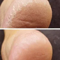 اسپا پدیکور و رفع ترکهای پا