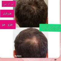 درمان تخصصی ریزش و قطع ریزش مو در کلینیک تخصصی|خدمات آرایشگری و زیبایی|برازجان, |دیوار