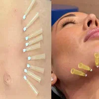 کارگاه آموزش جوانسازی پوست و لیفت با نخ-امبدینگ|خدمات آموزشی|تهران, فلسطین (میدان انقلاب)|دیوار