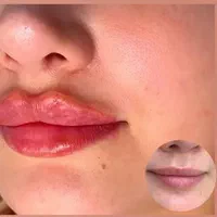 ژل بوتاکس خالبرداری فشیال زگیل تناسلی مطب زیبایی|خدمات آرایشگری و زیبایی|تبریز, |دیوار