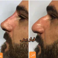 تزریق آنزیم بینی/فیلر بینی/شقیقه/ژل/درکلینیک پزشکی|خدمات آرایشگری و زیبایی|شیراز, زرهی|دیوار