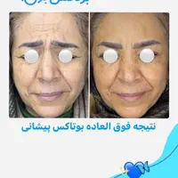 لیزر موی زائدفوق قوی الکساندرایت امریکایی درمهرشهر|خدمات آرایشگری و زیبایی|کرج, فاز ۲ مهرشهر|دیوار