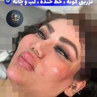 تزریق ژل و بوتاکس و مادلینگ خلیجی و هایفو درکلینیک|خدمات آرایشگری و زیبایی|کرمانشاه, |دیوار