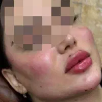 ژل،فیلر،بوتاکس،پی آر پی،مزوتراپی توسط پزشک در مطب