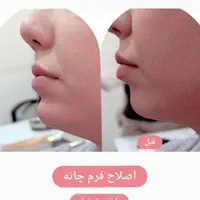 بوتاکس، ژل، چربی، لیزر، هایفوتراپی توسط پزشک|خدمات آرایشگری و زیبایی|یزد, |دیوار