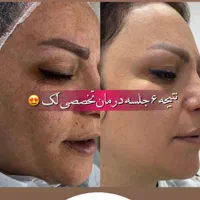 فیشال و خدمات تخصصی پوست توسط پیراپزشک در مطب پزشک|خدمات آرایشگری و زیبایی|مشهد, سجاد شهر|دیوار