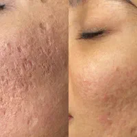 درمان مشکلات پوست مطب/مزوتراپی/فشیال/مزونیدلینگ/ژل|خدمات آرایشگری و زیبایی|مشهد, دانشجو|دیوار