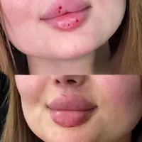 تزریق بوتاکس فیلر ژل لب روسی تخفیف ویژه