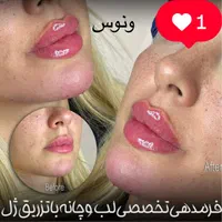 جشنواره50%تزریق ژل390مادلینگ هایفو لیزر مو ‌زائد|خدمات آرایشگری و زیبایی|تهران, ستارخان|دیوار