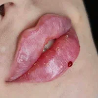 تزریق ژل لب روسی آنزیم زاویه سازی لیزر توسط پزشک|خدمات آرایشگری و زیبایی|تهران, صادقیه|دیوار