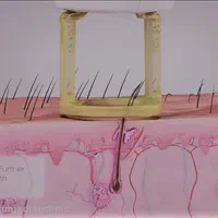 دستگاه لیزر مو غیر تماسی جنتل مکس پرو