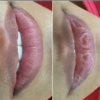 پاکسازی و فیشال پوست در کلینیک زیبایی-آموزش|خدمات آرایشگری و زیبایی|اهواز, کیانپارس |دیوار