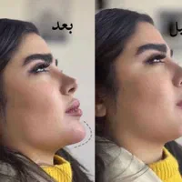 ژل لب بوتاکس لیزر فیلر هایفوبلفاروپلاستی|خدمات آرایشگری و زیبایی|مشهد, فرهنگ|دیوار