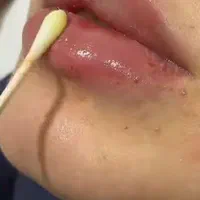 بوتاکس  (تخفیف فوق العاده )هایفوتراپی ژل لیزر|خدمات آرایشگری و زیبایی|مشهد, سرافرازان|دیوار