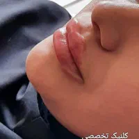 تزریق ژل و بوتاکس و کاشت نخ در کلینیک زیبایی|خدمات آرایشگری و زیبایی|خرم‌آباد, |دیوار