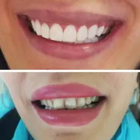 روکش دندان زیرکونیا مناسب|خدمات آرایشگری و زیبایی|تهران, افسریه|دیوار
