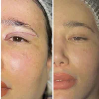 جراحی عمل پلک/بلفاروپلاستی/ساکشن غبغب/سانترال لب|خدمات آرایشگری و زیبایی|کرج, عظیمیه|دیوار