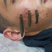 حجامت،زالودرمانی،فصد،برداشت خال و زگیل،درمنزل شما