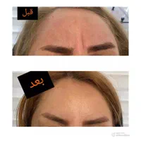 لیزر،بوتاکس،پی آرپی،مزوتراپی،کرایو زگیل توسط پزشک|خدمات آرایشگری و زیبایی|تربتحیدریه, |دیوار
