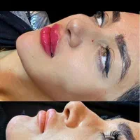 تزریق، فیلر ، بوتاکس، ژل ، آنزیم|خدمات آرایشگری و زیبایی|شیراز, سینما سعدی|دیوار