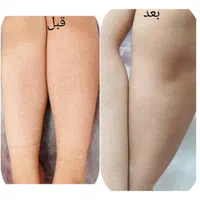 اپیلاسیون / تخصصی اپیلاسیون/ موم/ خانه اپیلاسیون|خدمات آرایشگری و زیبایی|مشهد, هنرستان|دیوار