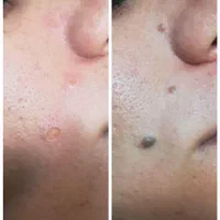لیزر پاک کردن تاتو کیوسوییچ هایفوفرکشنالco2|خدمات آرایشگری و زیبایی|اهواز, کیانپارس |دیوار