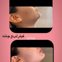 تزریق ژل بوتاکس لیزرمو مزو فیلرلب روسی لیفت صورت|خدمات آرایشگری و زیبایی|تهران, پونک|دیوار