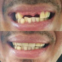 ساخت دست دندان مصنوعی طرح لمینیت و لبخند باضمانت|خدمات آرایشگری و زیبایی|تهران, طیب|دیوار