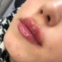 بوتاکس،فیلر، لب روسی،‌جوانسازی پوست، مزو توسط پزشک