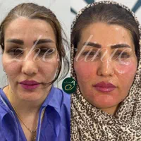 تزریق چربی فول فیس