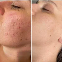 نیازمند مدل پاکسازی فقد هزینه متریال گرفته میشه|خدمات آرایشگری و زیبایی|امیدیه, |دیوار