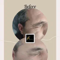 جشنواره فیلر ژل بوتاکس prpمزوتراپی لیزر توسط پزشک|خدمات آرایشگری و زیبایی|کرمان, |دیوار