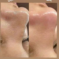 نیازمند مدل پاکسازی فقد هزینه متریال گرفته میشه|خدمات آرایشگری و زیبایی|امیدیه, |دیوار