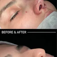 عمل جراحی بینی با دستگاه پیزو 22/لیفت صورت/پلک|خدمات آرایشگری و زیبایی|تهران, توانیر|دیوار