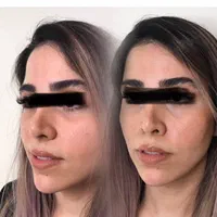 تزریق چربی صورت دست با سن بیکینی در کلینیک تخصصی|خدمات آرایشگری و زیبایی|تهران, صادقیه|دیوار