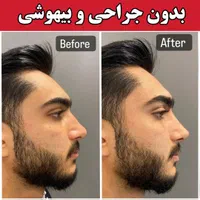 فرم دهی بینی بدون جراحی و بیهوشی رینوپلاستی NOA|خدمات آرایشگری و زیبایی|مشهد, هفت تیر (حافظ)|دیوار