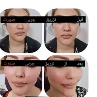 جشنواره بهاره  تزریق چربی جراحی پلک بلفارو بینی|خدمات آرایشگری و زیبایی|تهران, صادقیه|دیوار