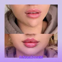 تخفیف تزریق ژل بوتاکس لیفت نخ هایفو فیلرلب لیزر|خدمات آرایشگری و زیبایی|تهران, سعادت‌آباد|دیوار