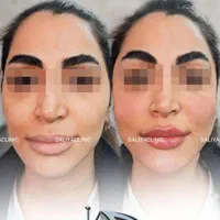 تزریق ژل (فیلر)وبوتاکس لیفت با نخ‌ مادلینگ درشرق|خدمات آرایشگری و زیبایی|تهران, نارمک|دیوار