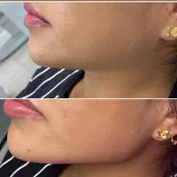 ژل لب فیلر بوتاکس لیزر مو هایفو پی آرپی خال برداری|خدمات آرایشگری و زیبایی|مشهد, آزادشهر|دیوار