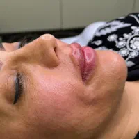جشنواره تزریق ژل ، بوتاکس ،فیلر بادی ، نخ ،لیزر|خدمات آرایشگری و زیبایی|شیراز, فرهنگ شهر|دیوار