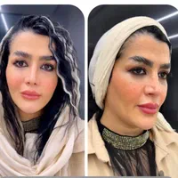 تزریق ژل مدل زاویه،گونه،چونه،لب|خدمات آرایشگری و زیبایی|تهران, امام زاده حسن|دیوار