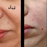 تخفیف ویژه عیدانه ژل فیلربوتاکس آنزیم