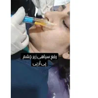 فیلرژل بوتاکس پی ارپی لاغر تزریق چربی مزولیزرهایفو|خدمات آرایشگری و زیبایی|تبریز, |دیوار