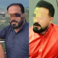 کاشت موی طبیعی به روش fit ،و سوپر sut|خدمات آرایشگری و زیبایی|اهواز, کیانپارس |دیوار